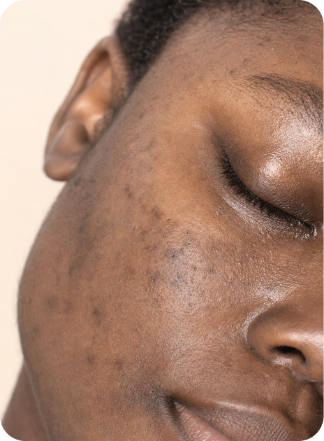 Dark spots & discoloration