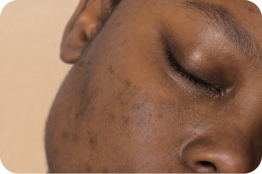 Dark spots